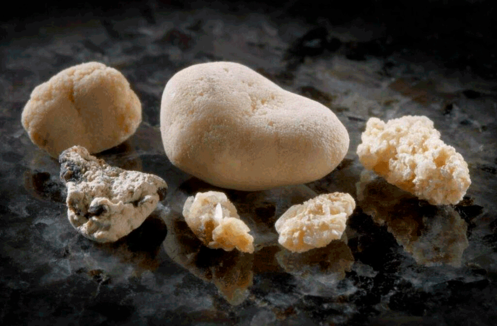 kidney stones